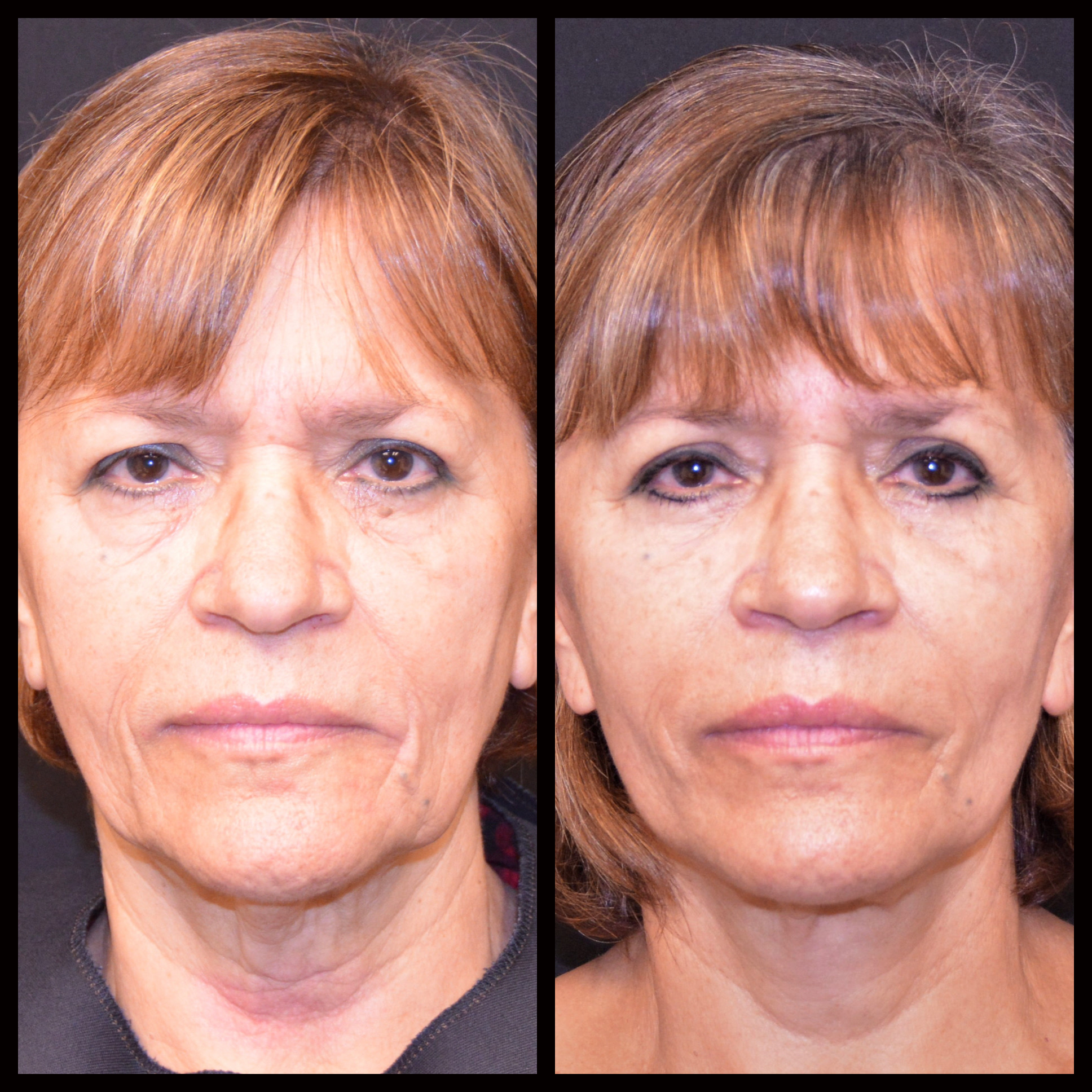 Before and after facelift